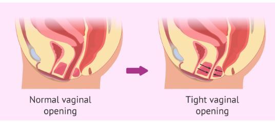 حقایق ناگفته در مورد بیماری واژینیسموس در زنان