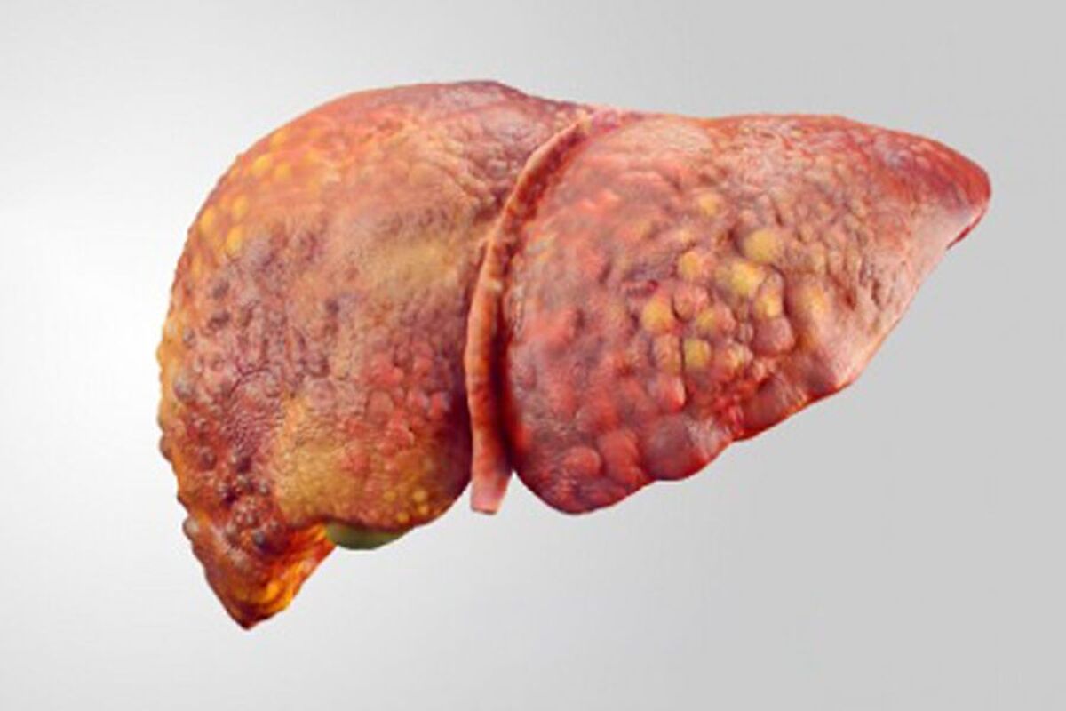 دانشگاه پزشکی دولتی اول مسکو پیشنهاد می‌کند که سیروز کبدی با تأثیر بر میکروبیوتای روده درمان شود
