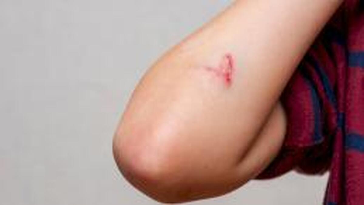 دانشمندان راهی برای درمان زخم‌ها بدون ایجاد جای زخم پیدا کرده‌اند