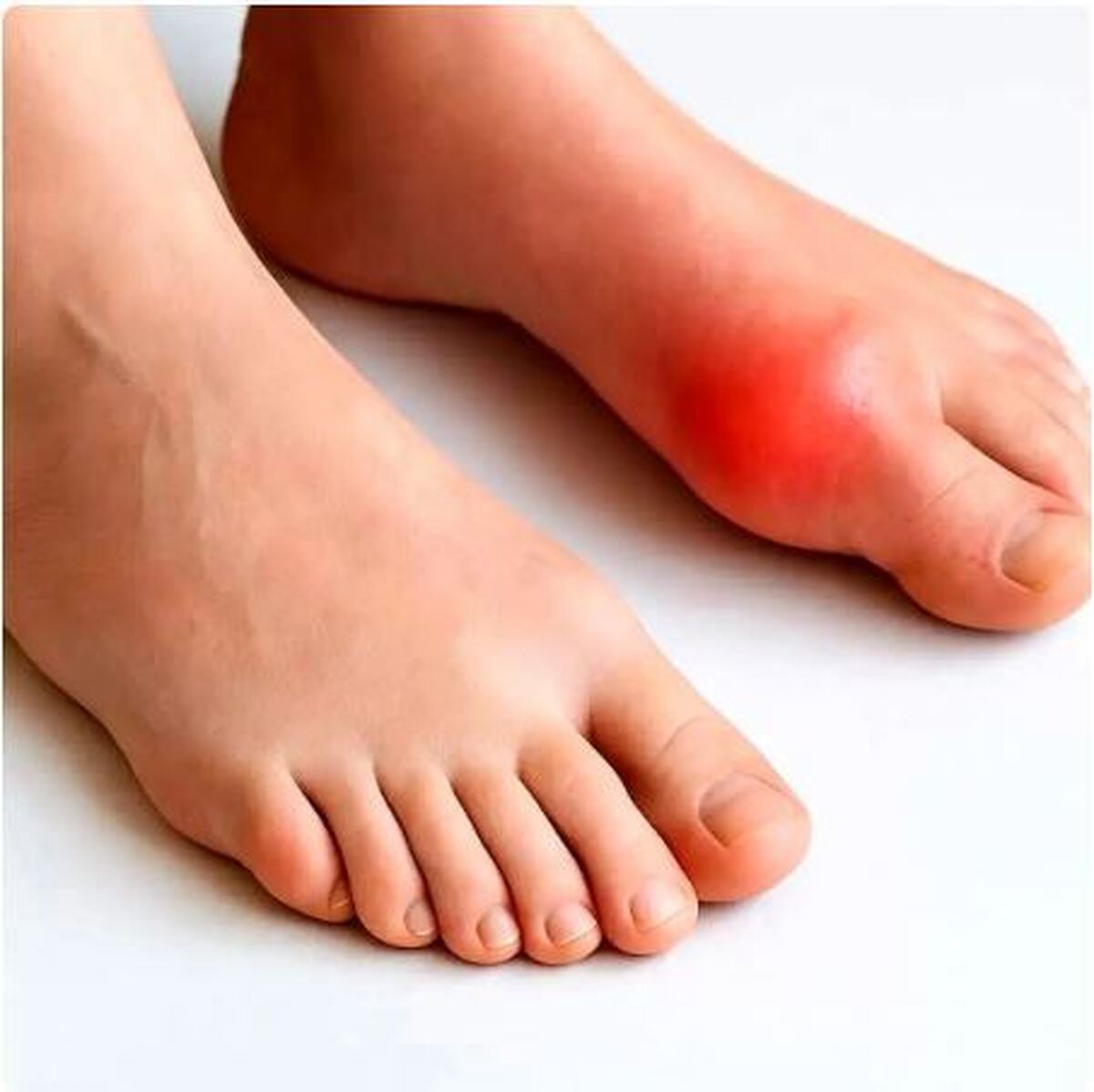 نوع پخت گوشت و تاثیر آن در ابتلا به نقرس!