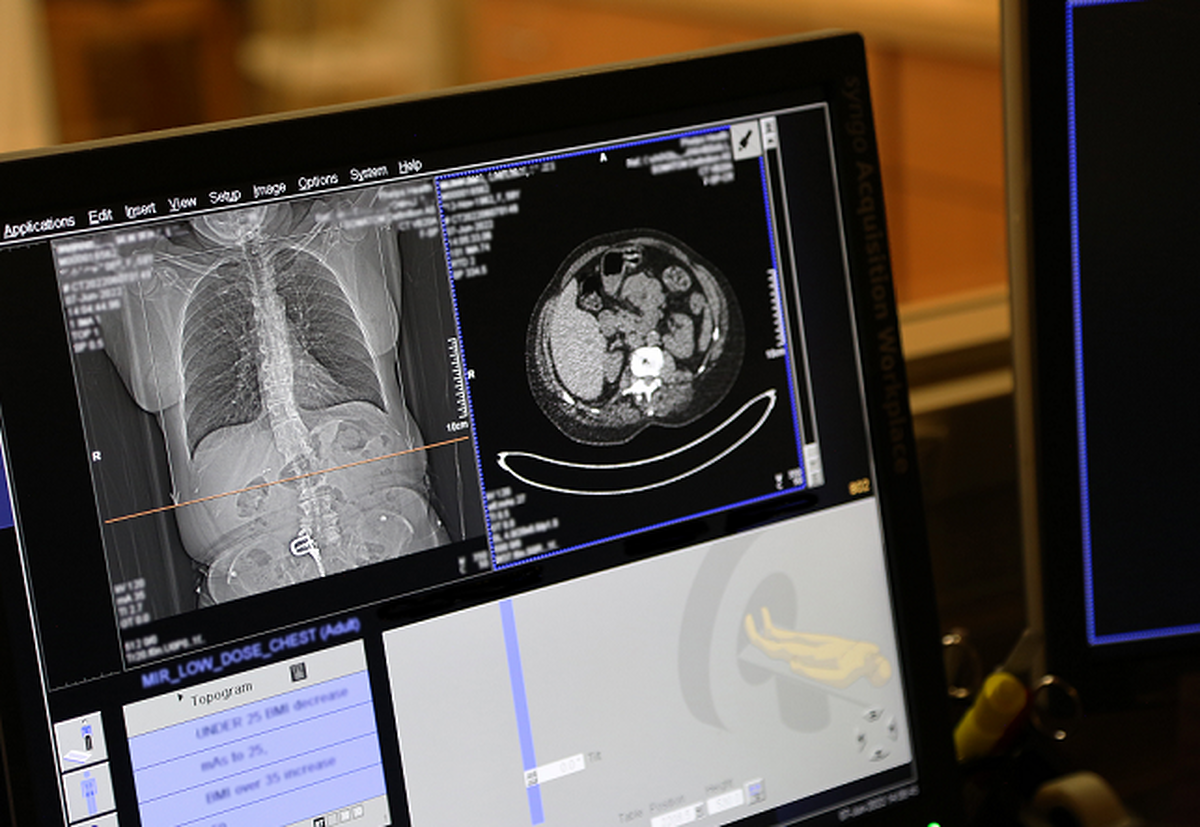 در مراحل اولیه سرطان ریه چه علائمی دارد؟