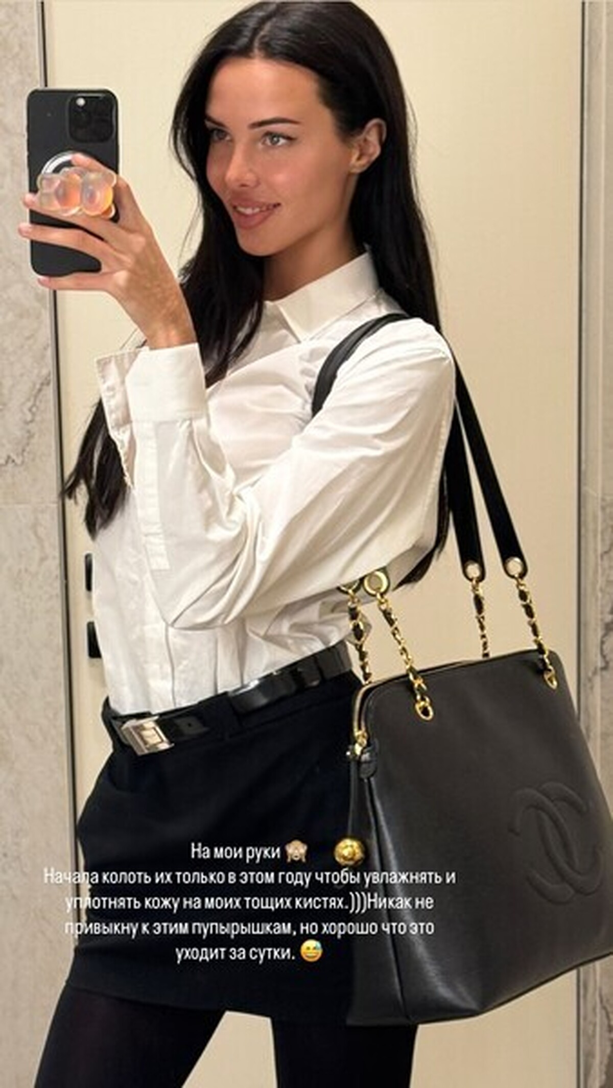 نامزد سابق تیماتی عوارض تزریقات زیبایی روی بازوهایش را نشان داد: 