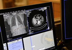 در مراحل اولیه سرطان ریه چه علائمی دارد؟