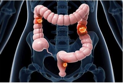 رهایی از درد و مشکلات یبوست با چند راهکار ساده! رهایی از درد و مشکلات یبوست با چند راهکار ساده!