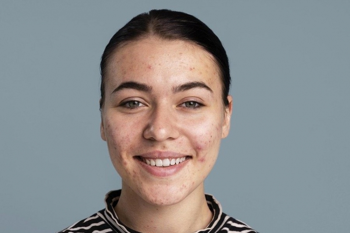 JAMA Dermatology: مهارکننده‌های Janus Kinase خطر آکنه را افزایش می‌دهند