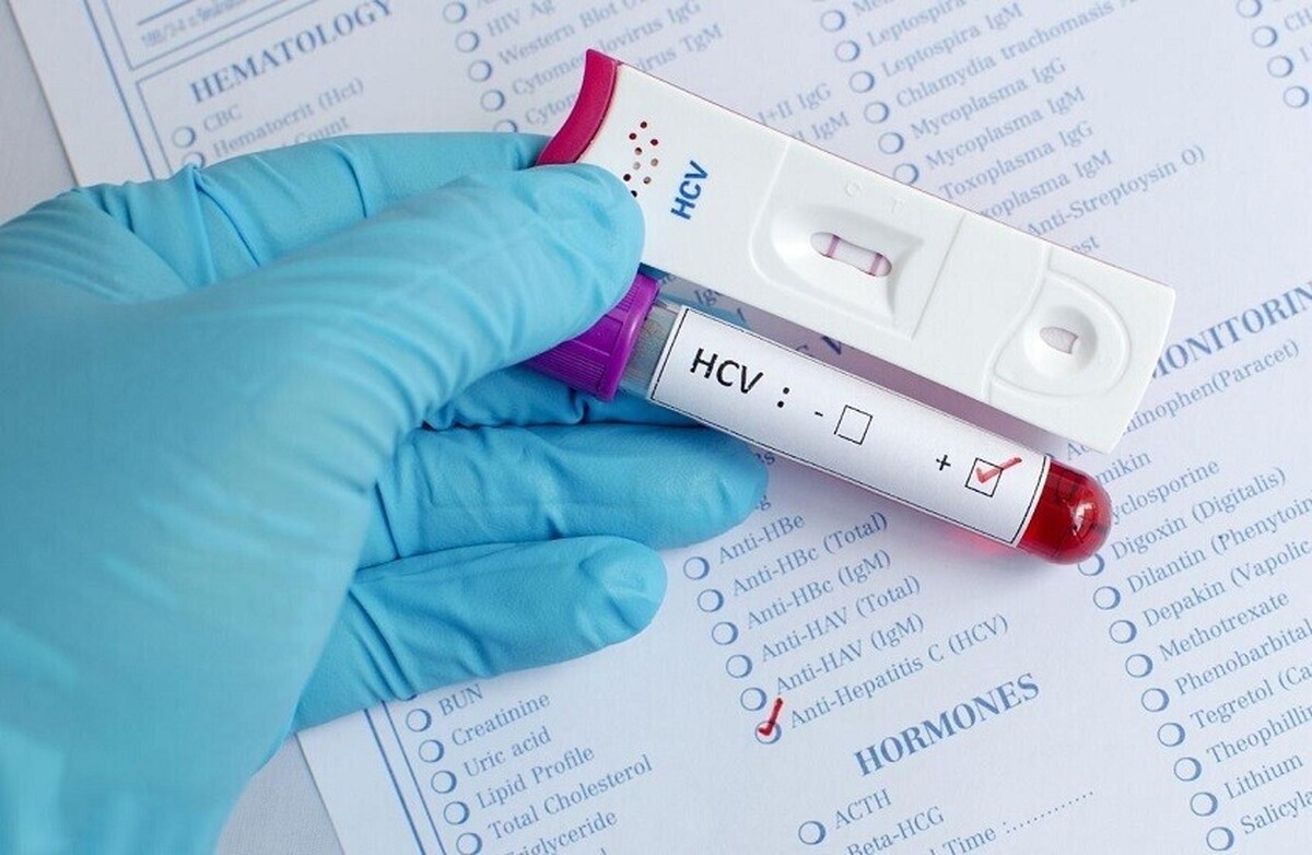 روسیه اولین آزمایش سریع جهان برای تشخیص هپاتیت C را توسعه می‌دهد