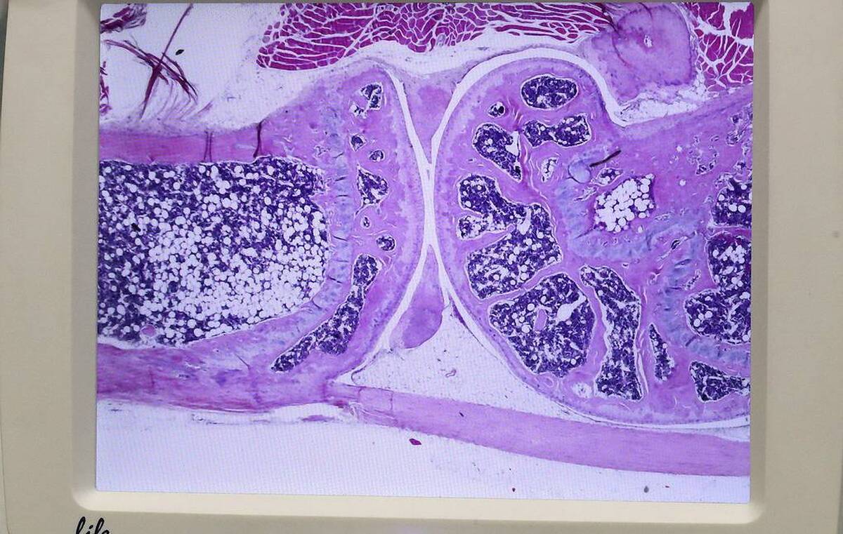 یک شبکه عصبی، اثربخشی داروی مالاریا را در درمان پوکی استخوان نشان داده است