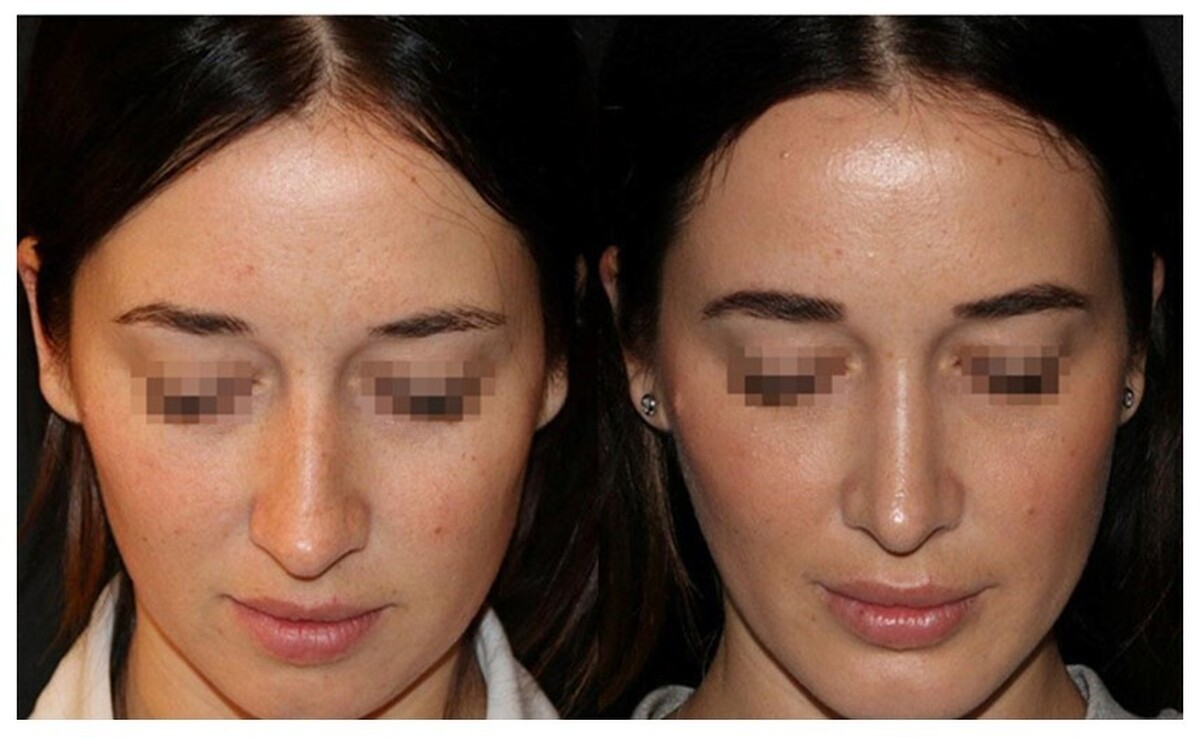 سپتوپلاستی در درمان علائم انحراف تیغه بینی مؤثرتر از اسپری‌های بینی است