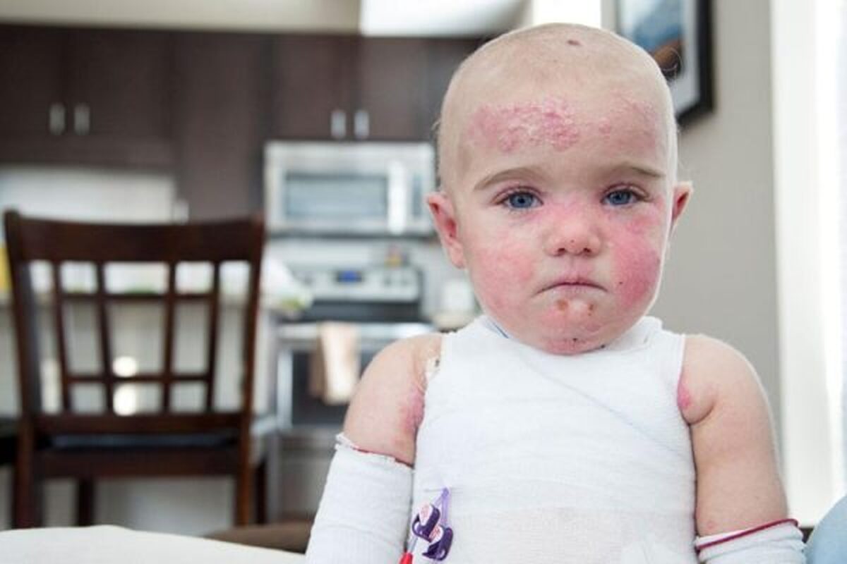 ازدواج فامیلی و به وجود آمدن این بیماری پوستی خطرناک