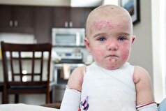 ازدواج فامیلی و به وجود آمدن این بیماری پوستی خطرناک