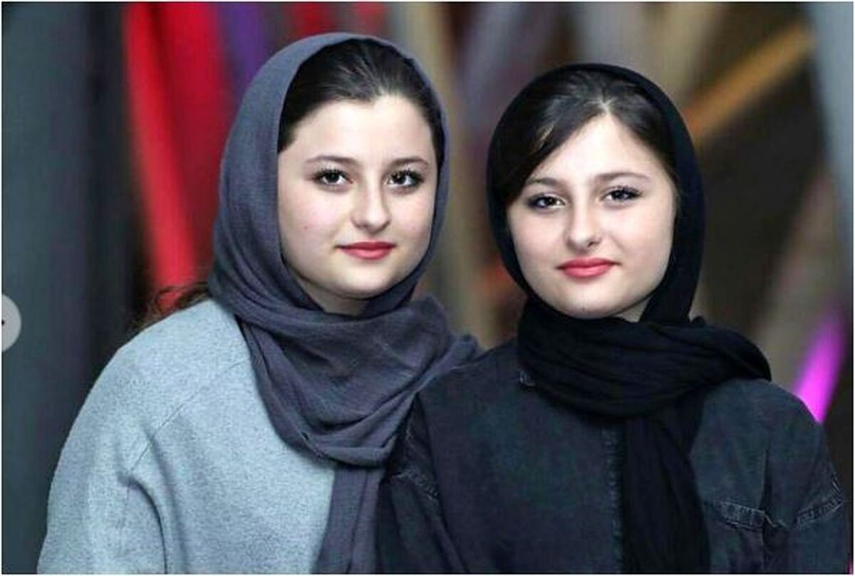 دو قلو‌های همسان به هم چسبیده جدید در سوئد+عکس