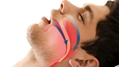 آشنایی با انواع آپنه خواب! +علائم!