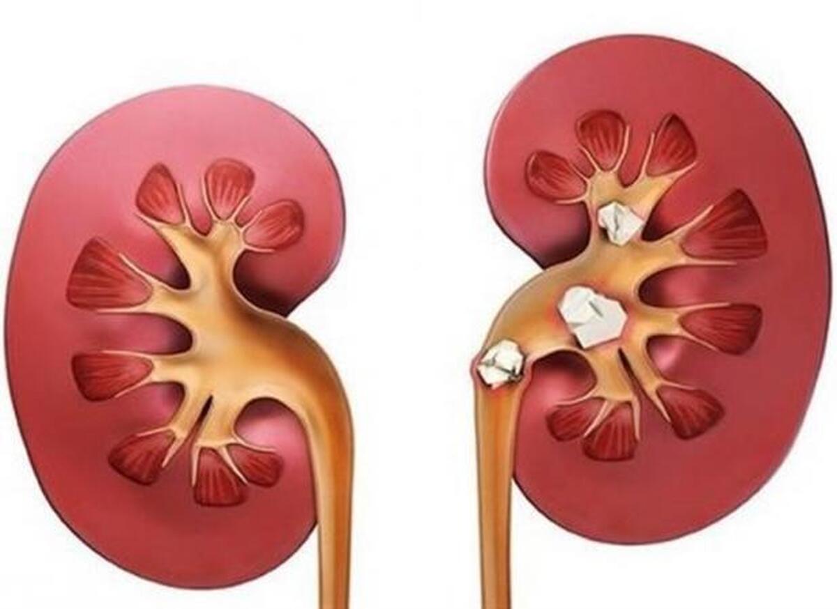 نارسایی مزمن کلیه نهمین علت اصلی مرگ‌ومیر در جهان!