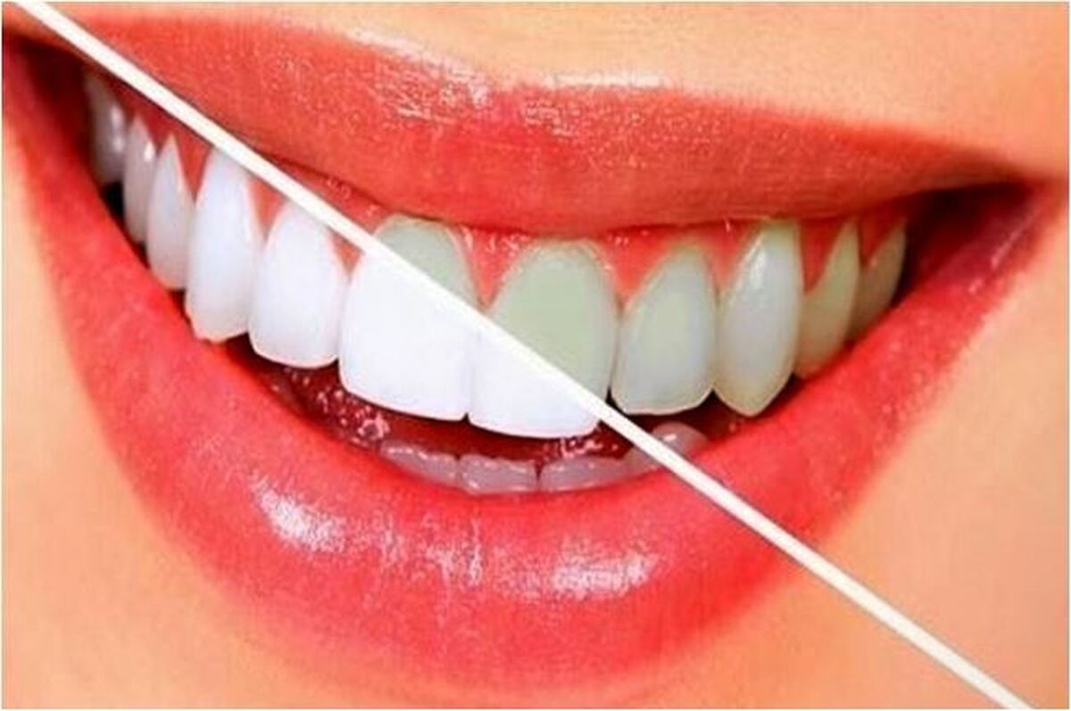 لیست مواد غذایی که دندان هایتان را سفید و تمیز می‌کند