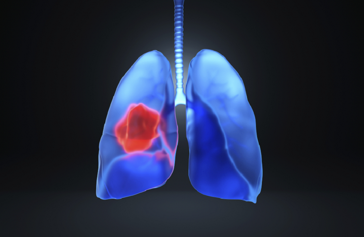 کشف عامل اصلی ابتلا به سرطان ریه در مراحل اولیه