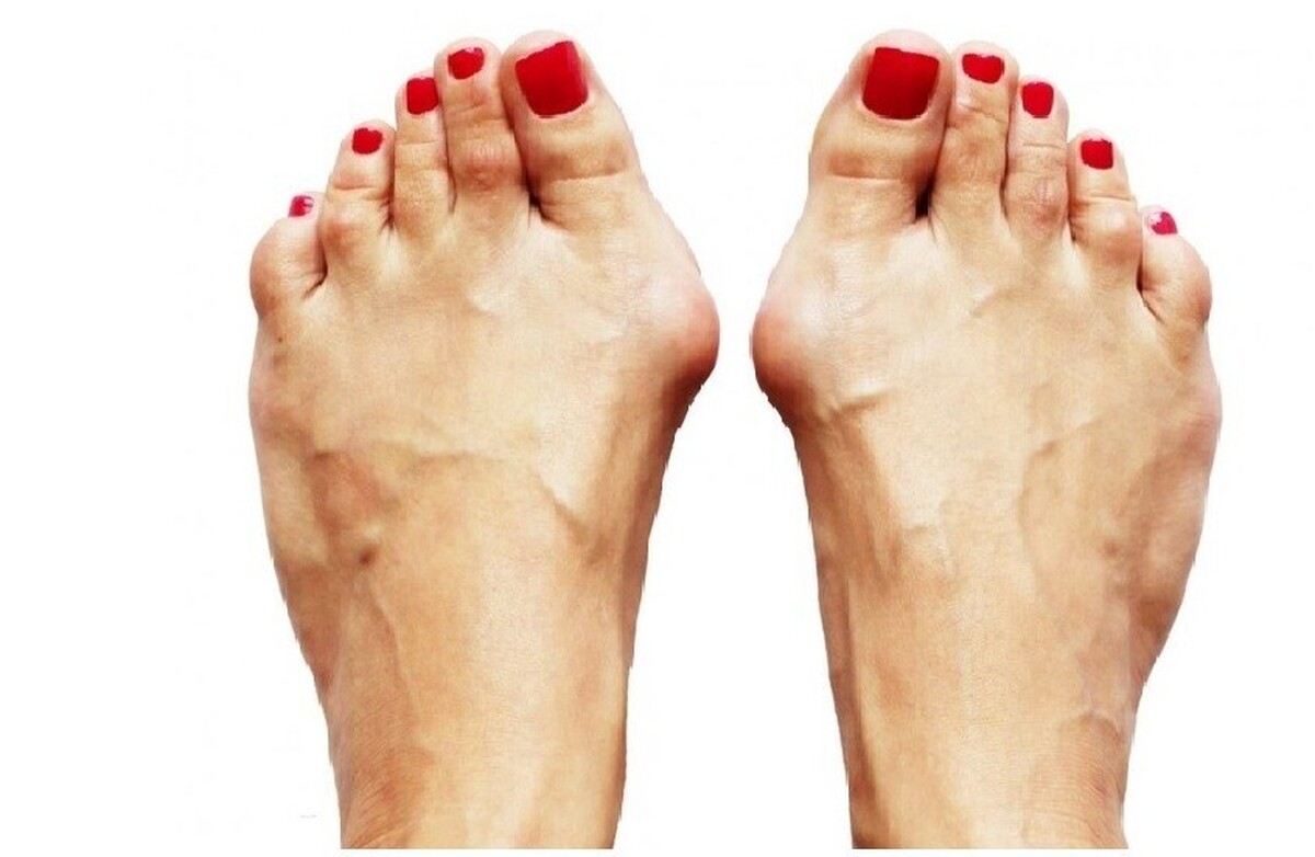 یک پزشک علت تورم انگشت شست پا را توضیح می‌دهد