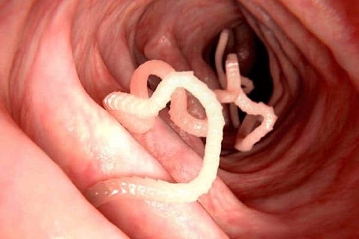 بیماری‌های انگلی چه نشانه‌ای دارد؟