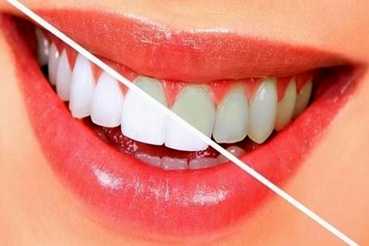 چه خوراکی‌هایی بخوریم تا دندان‌های مان از سفیدی برق بزند؟