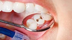 علت پوسیدگی مکرر دندان‌ها چیست؟