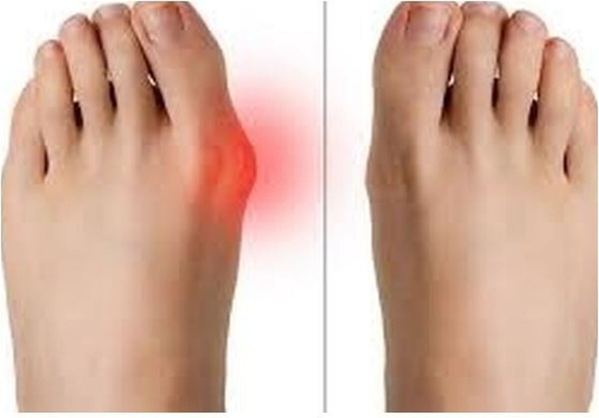 درد و التهاب در ناحیه مفصل شست پا و بررسی عوامل ایجاد آن