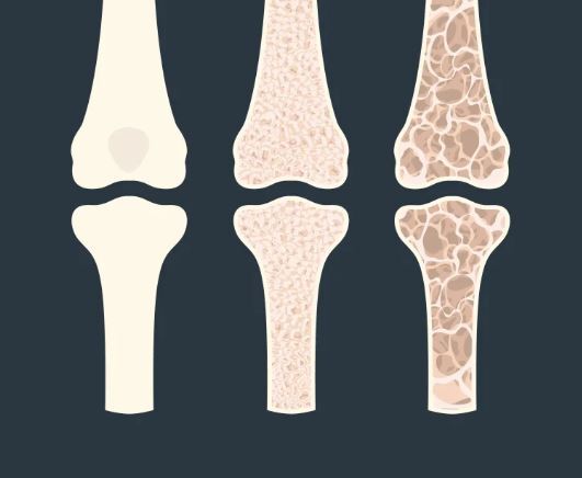 کاهش وزن سریع با ژیم غذایی چه آسیب‌هایی به بدن وارد می‌کند؟