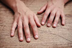 علت سیانوز دست چیست؟