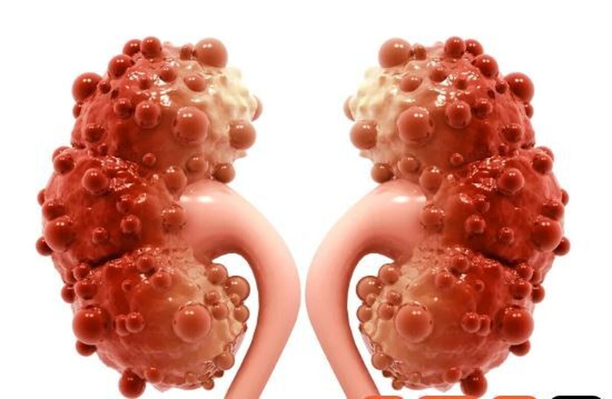 آیا به وجود آمدن کیست کورتیکال در کلیه نگران کننده است؟