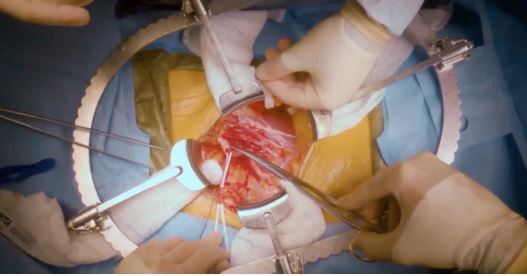 آیا به وجود آمدن کیست کورتیکال در کلیه نگران کننده است؟ آیا به وجود آمدن کیست کورتیکال در کلیه نگران کننده است؟