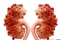 آیا به وجود آمدن کیست کورتیکال در کلیه نگران کننده است؟