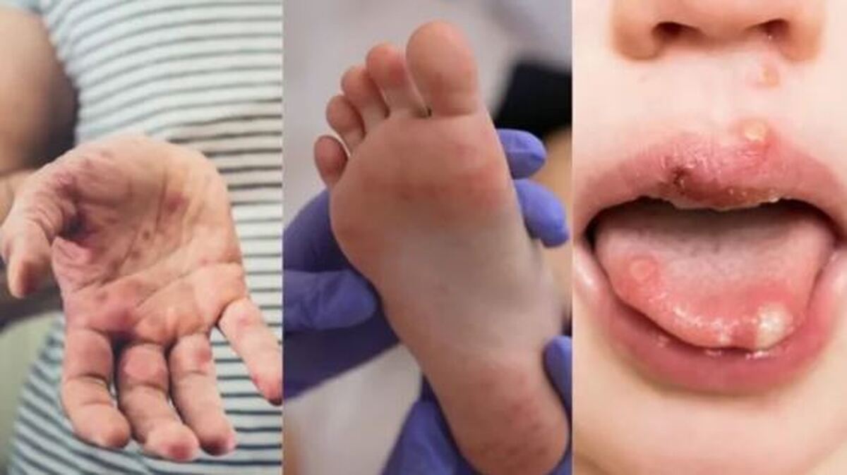 علائم و نشانه‌های تب برفکی در انسان‌ها و میزان خطر آن