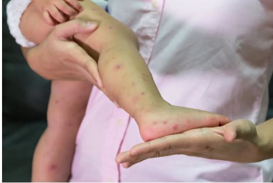 علائم و نشانه‌های تب برفکی در انسان‌ها و میزان خطر آن