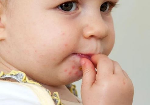 علائم و نشانه‌های تب برفکی در انسان‌ها و میزان خطر آن