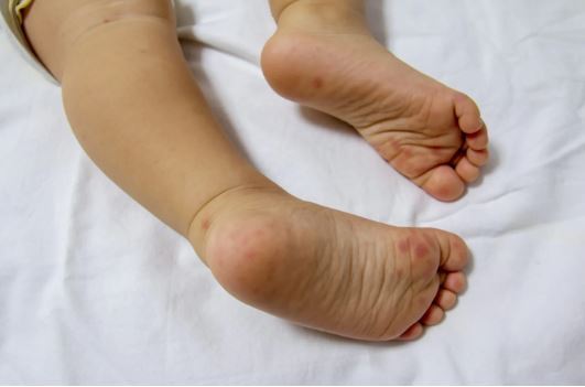 علائم و نشانه‌های تب برفکی در انسان‌ها و میزان خطر آن