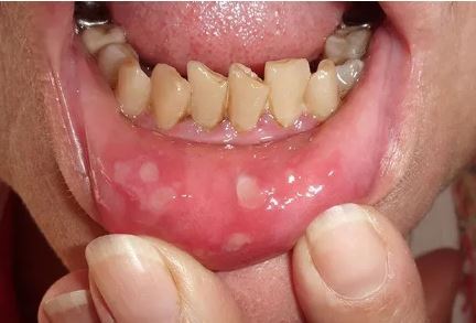 علائم و نشانه‌های تب برفکی در انسان‌ها و میزان خطر آن