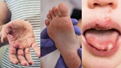 علائم و نشانه‌های تب برفکی در انسان‌ها و میزان خطر آن