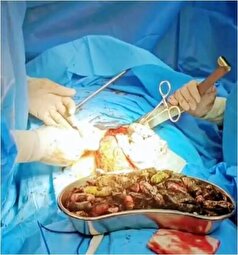 جزئیات باور نکردنی خروج ۹۰ بسته مواد مخدر از معده و روده یک بیمار در این شهر