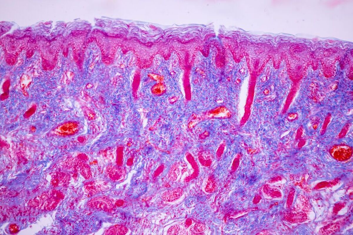 ژن درمانی جدید، کودکان مبتلا به یک نقص ایمنی نادر را به طور کامل درمان می‌کند