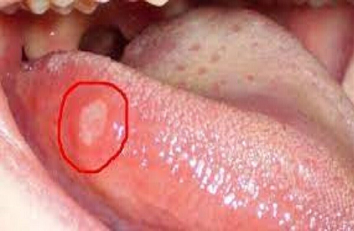 علائم پنهان سرطان که روی زبان ظاهر می‌شوند