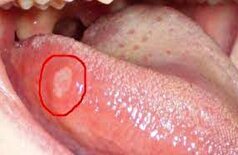 علائم پنهان سرطان که روی زبان ظاهر می‌شوند