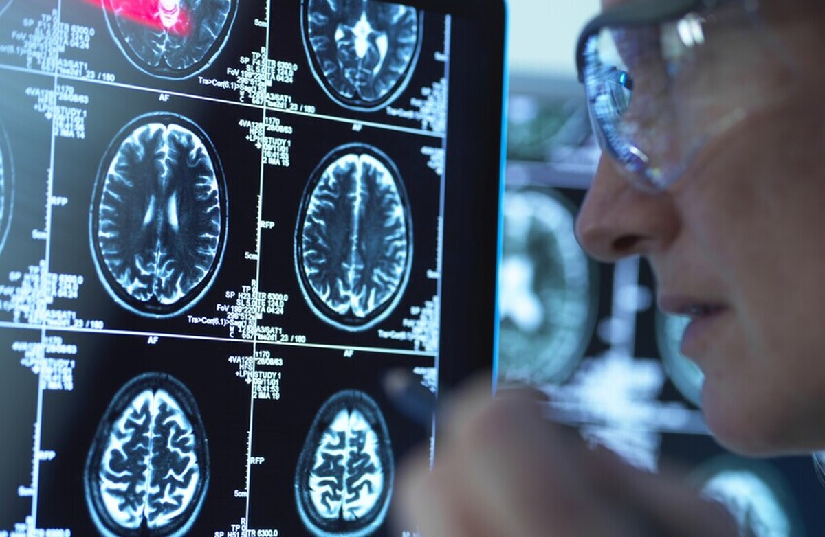 کشف مکانیسم انقلابی برای مبارزه با آلزایمر با استفاده از یک ماده طبیعی در بدن