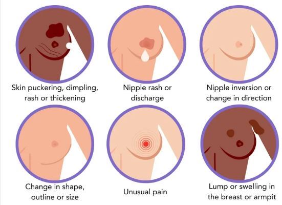 علائم مهم سرطان سینه که نادیده گرفته می‌شوند