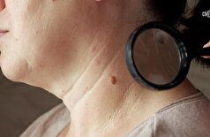 خال‌های مشکوک: علائم هشدار دهنده و خطرناک‌ترین مکان‌های بدن