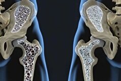 رژیم غذایی مناسب در امان ماندن از پوکی استخوان