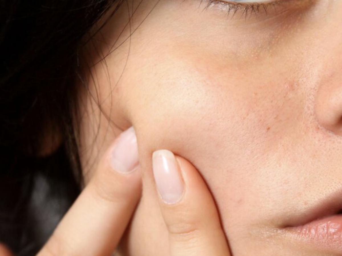 Nanoscale: مولکول جدید قدرتمندی که می‌تواند در مبارزه با آکنه، انقلابی ایجاد کند