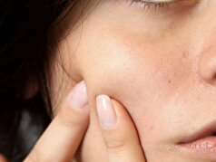 Nanoscale: مولکول جدید قدرتمندی که می‌تواند در مبارزه با آکنه، انقلابی ایجاد کند