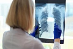 سندروم خستگی مزمن چیست؟ چه نشانه‌هایی دارد؟