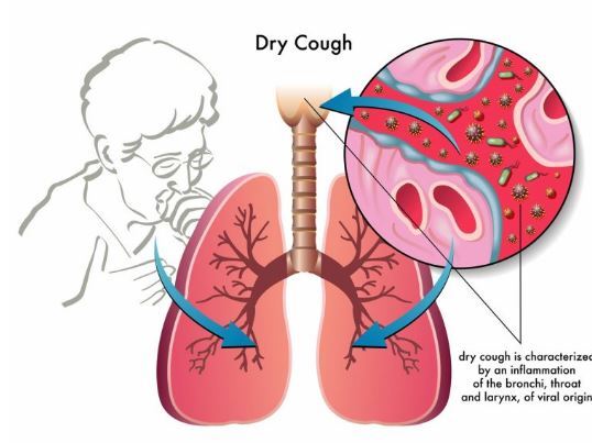 از روی صدای سرفه علت آن را تشخیص دهید! از روی صدای سرفه علت آن را تشخیص دهید!