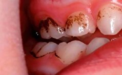 خوراکی‌های تقویت کننده دندان‌ها را بشناسید