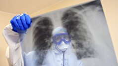 یک پزشک در مورد تشخیص ذات‌الریه بدون علامت صحبت کرد.