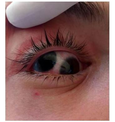 کاشت ایمپلنت در ناحیه تناسلی؛ قدم بعدی مردی که تمام بدنش را تتو کرده بود! کاشت ایمپلنت در ناحیه تناسلی؛ قدم بعدی مردی که تمام بدنش را تتو کرده بود!